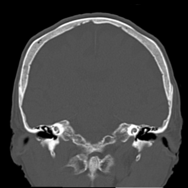 Biparietal osteodystrophy (Radiopaedia 46109-50463 Coronal bone window 59).jpg