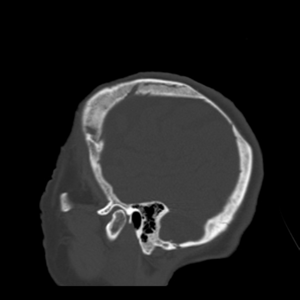 Biparietal osteodystrophy (Radiopaedia 46109-50463 Sagittal bone window 19).jpg