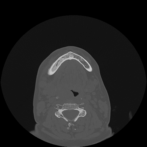 File:Bisphosphonate-related osteonecrosis of the jaw (Radiopaedia 71324-81642 Axial bone window 31).jpg