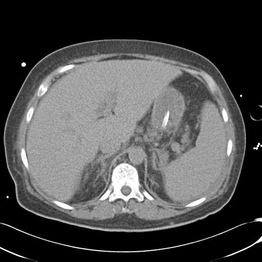 Bladder rupture post renal biopsy (Radiopaedia 30863-31572 Axial non-contrast 23).jpg