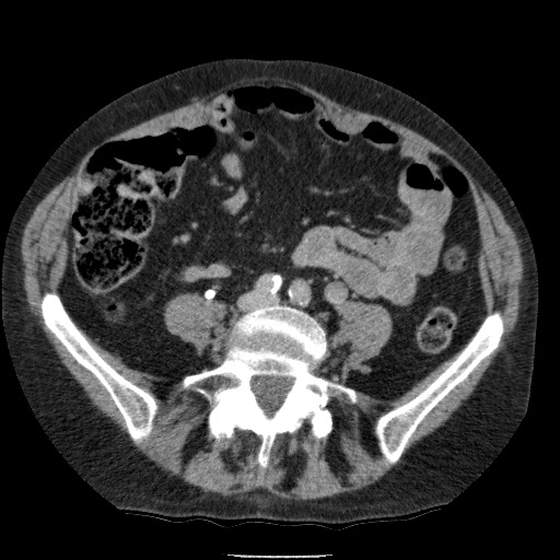 Bladder tumor detected on trauma CT (Radiopaedia 51809-57609 C 87).jpg