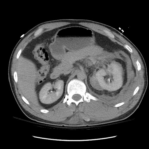 Blunt abdominal trauma with solid organ and musculoskelatal injury with active extravasation (Radiopaedia 68364-77895 Axial C+ delayed 46).jpg