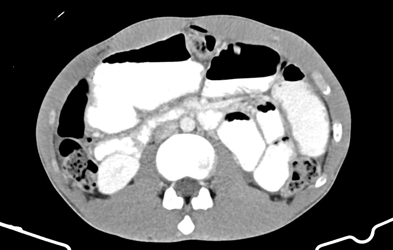 Blunt injury to the small bowel (Radiopaedia 74953-85987 A 74).jpg