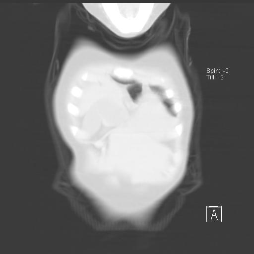 File:Bochdalek diaphragmatic hernia (Radiopaedia 38866-41059 Coronal lung window 2).jpg