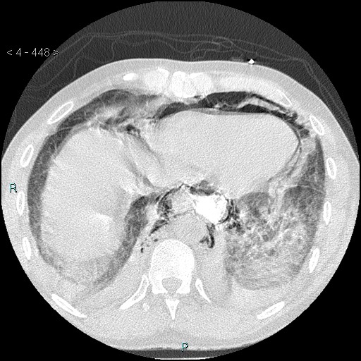 File:Boerhaave syndrome (Radiopaedia 27683-27897 lung window 80).jpg