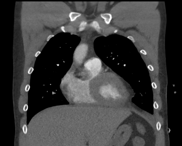 File:Boerhaave syndrome (Radiopaedia 39382-41660 C 29).png