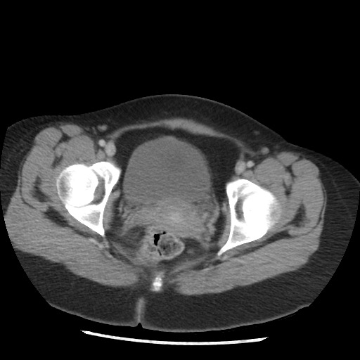 File:Borderline mucinous tumor (ovary) (Radiopaedia 78228-90808 A 133).jpg