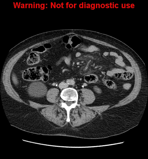 File:Bosniak renal cyst - type II (Radiopaedia 23404-23468 F 36).jpg