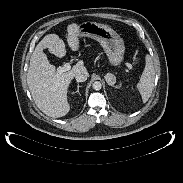 Bosniak renal cyst - type IV (Radiopaedia 24244-24518 C 76).jpg
