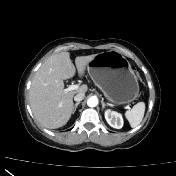 Bosniak renal cyst - type I (Radiopaedia 27479-27675 renal cortical phase 18).jpg