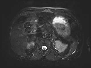 File:Bouveret syndrome (Radiopaedia 61017-68856 Axial MRCP 20).jpg