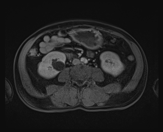 File:Bouveret syndrome (Radiopaedia 61017-68856 Axial T1 C+ fat sat 56).jpg