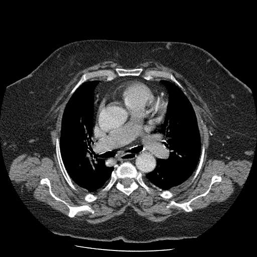 Bovine aortic arch - right internal mammary vein drains into the superior vena cava (Radiopaedia 63296-71875 A 63).jpg