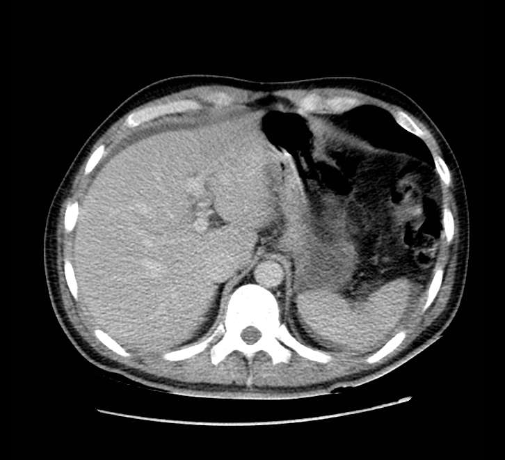 Bowel obstruction from colon carcinoma (Radiopaedia 22995-23028 A 16).jpg