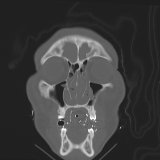 Brain contusions, internal carotid artery dissection and base of skull fracture (Radiopaedia 34089-35339 Coronal bone window 16).png