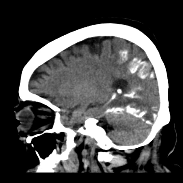 Brain cortical laminar necrosis (Radiopaedia 25822-25971 non-contrast 34).jpg