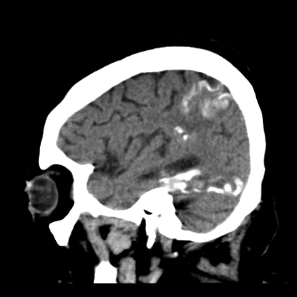 Brain cortical laminar necrosis (Radiopaedia 25822-25971 non-contrast 38).jpg