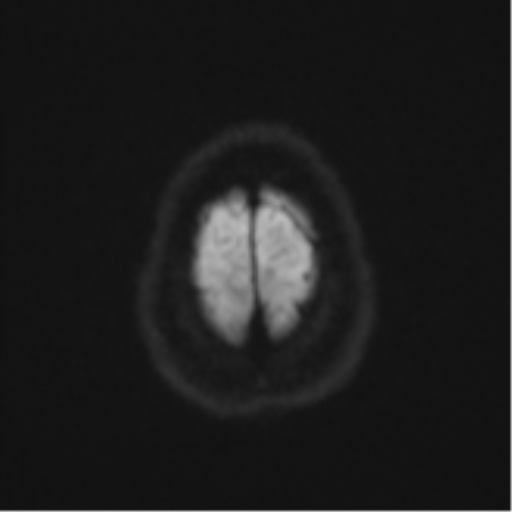 Brain death (Radiopaedia 43754-47237 Axial DWI 54).png