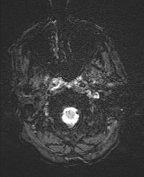 Brain metastases - lung cancer primary (Radiopaedia 75060-86115 Axial SWI 4).jpg