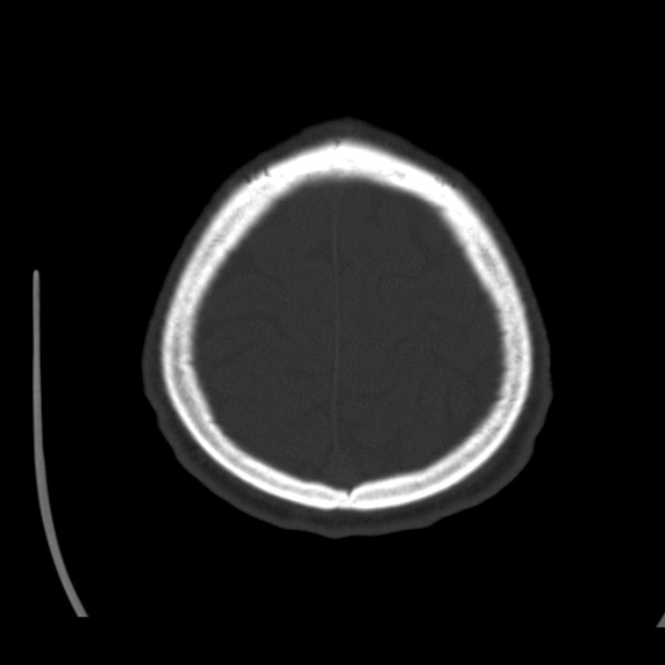 Brain metastases from lung cancer (Radiopaedia 24480-24781 Axial bone window 44).jpg