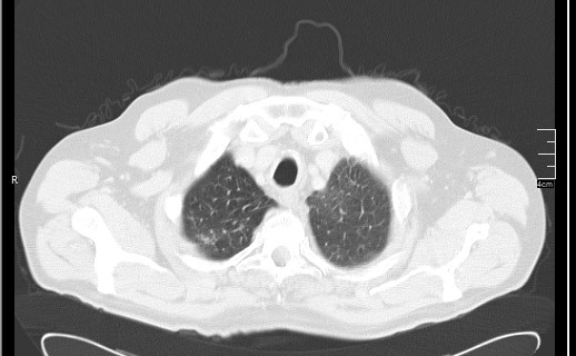 File:Brain metastases from squamocellular lung cancer (Radiopaedia 56515-63219 Axial lung window 14).jpg