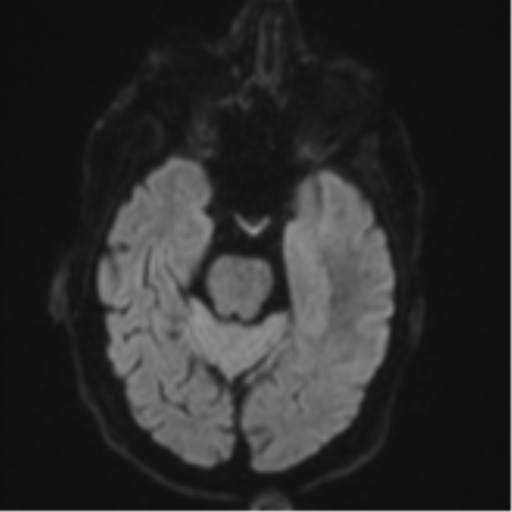 Brain metastasis (lung cancer) (Radiopaedia 48289-53179 Axial DWI 37).png