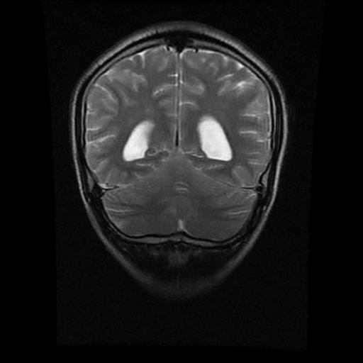 File:Brainstem glioma (Radiopaedia 30923-31624 Coronal T2 5).jpg