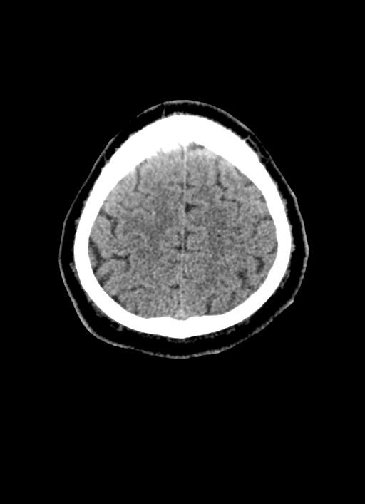 Brainstem hemorrhage (Radiopaedia 81294-94976 Axial non-contrast 14).jpg