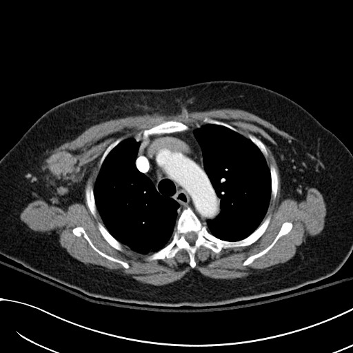 Breast carcinoma with pathological hip fracture (Radiopaedia 60314-67974 A 16).jpg