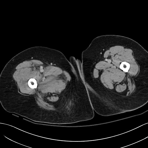Breast carcinoma with pathological hip fracture (Radiopaedia 60314-67974 B 88).jpg