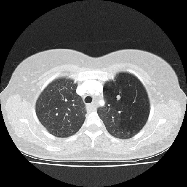 Bronchial atresia (Radiopaedia 22965-22992 Axial lung window 39).jpg