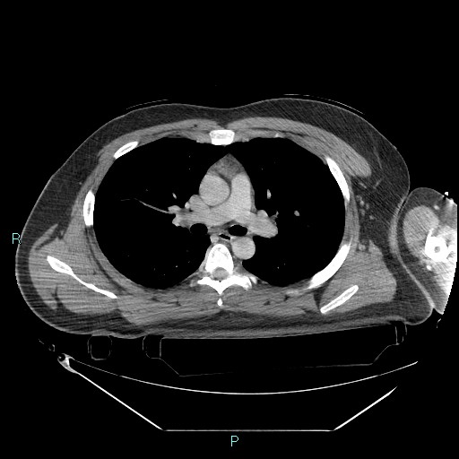File:Bronchial carcinoid tumor (Radiopaedia 78272-90870 C 53).jpg