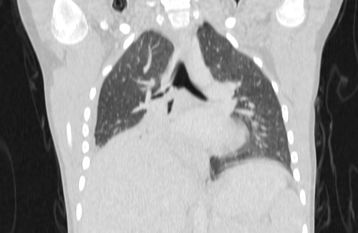 Bronchial mucoepidermoid carcinoma (Radiopaedia 57023-63895 Coronal lung window 21).jpg