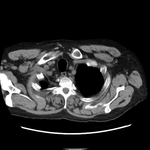 Bronchial stenosis - lung transplant (Radiopaedia 73133-83848 Axial non-contrast 8).jpg