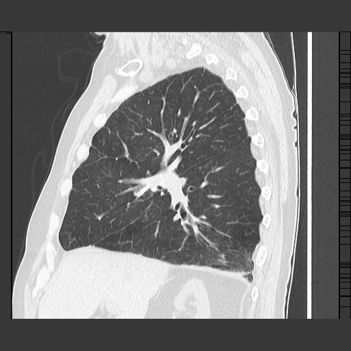 Bronchial stenosis - lung transplant (Radiopaedia 73133-83848 Sagittal lung window 25).jpg