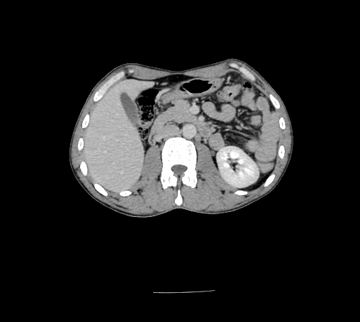 File:Bronchiectasis in Crohn disease (Radiopaedia 60311-67977 B 68).jpg