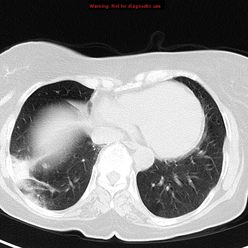 File:Bronchoalveolar carcinoma (BAC) (Radiopaedia 13436-13392 Axial lung window 37).jpg