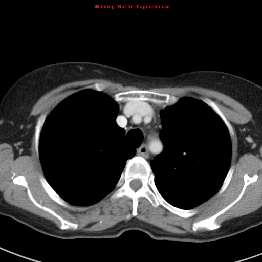 File:Bronchoalveolar carcinoma (BAC) (Radiopaedia 13436-13392 B 13).jpg