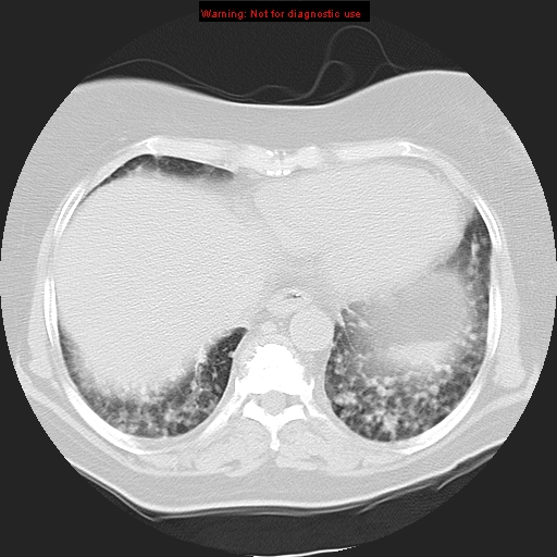 Bronchoalveolar carcinoma (Radiopaedia 13224-13233 Axial lung window 34).jpg