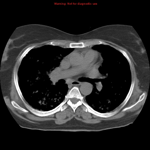 Bronchoalveolar carcinoma (Radiopaedia 13224-13233 Axial non-contrast 22).jpg