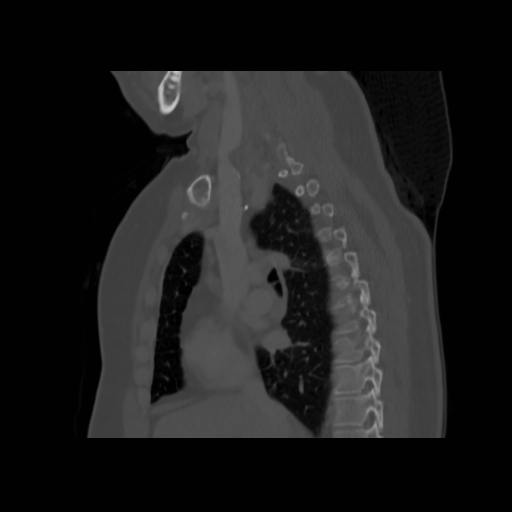 Bronchogenic carcinoma (Radiopaedia 73497-84262 Sagittal bone window 72).jpg