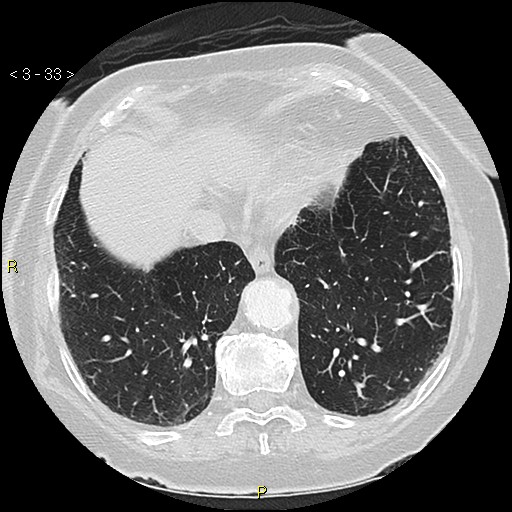 Bronchogenic carcinoma as an incidental finding (Radiopaedia 16453-16130 Axial lung window 33).jpg