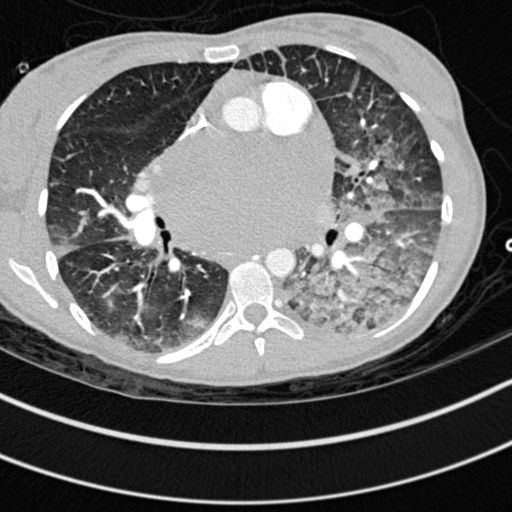 Bronchogenic cyst (Radiopaedia 77801-90071 Axial lung window 37).jpg