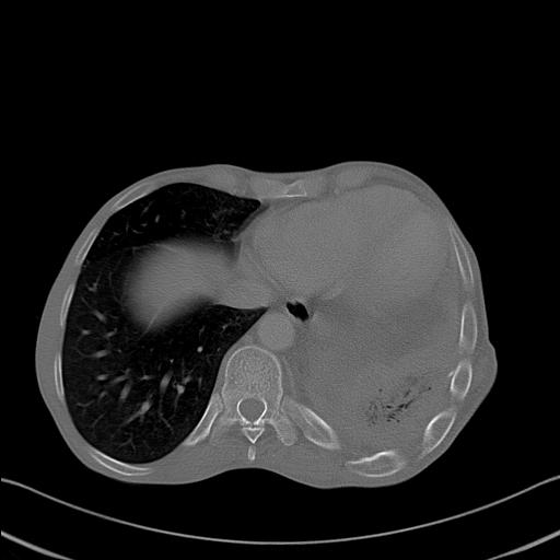 File:Bronchopleural fistula secondary to tuberculosis (Radiopaedia 20415-20322 Axial bone window 23).jpg