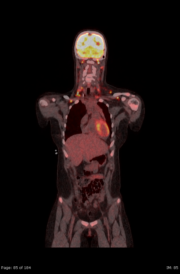 Brown fat uptake (FDG PET-CT) (Radiopaedia 77392-89513 Fused coronal 43).jpg