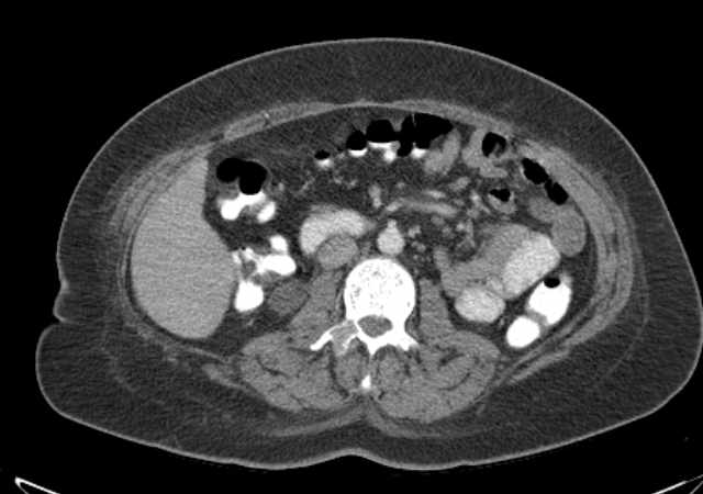Brown tumors compressing the spinal cord (Radiopaedia 68442-77988 E 56).jpg