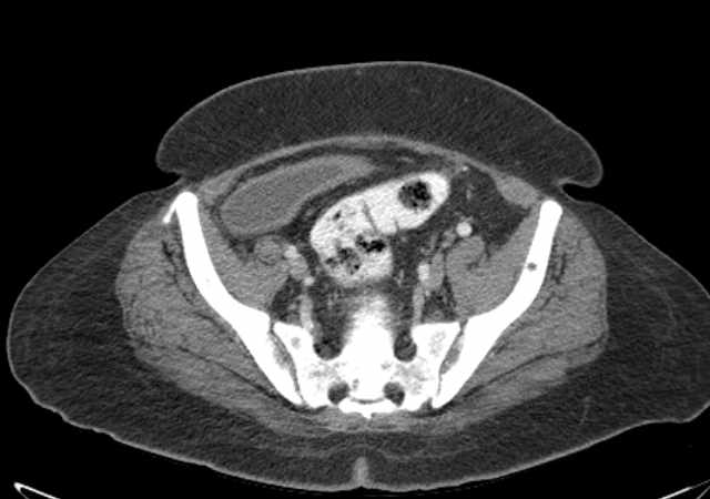 Brown tumors compressing the spinal cord (Radiopaedia 68442-77988 E 99).jpg