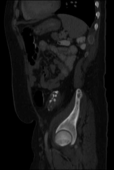 Brown tumors compressing the spinal cord (Radiopaedia 68442-77988 H 41).jpg