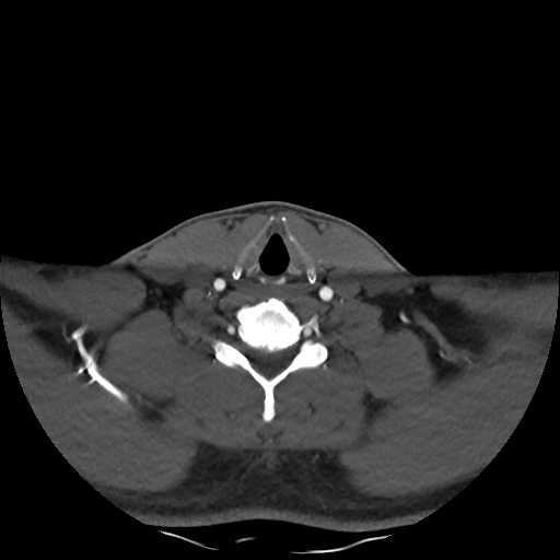 Buccal fat pad arteriovenous malformation (Radiopaedia 70936-81144 A 82).jpg