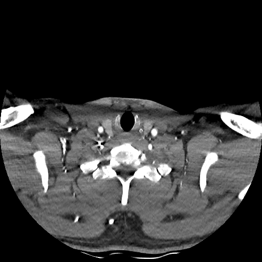 Buccal fat pad arteriovenous malformation (Radiopaedia 70936-81144 D 68).jpg